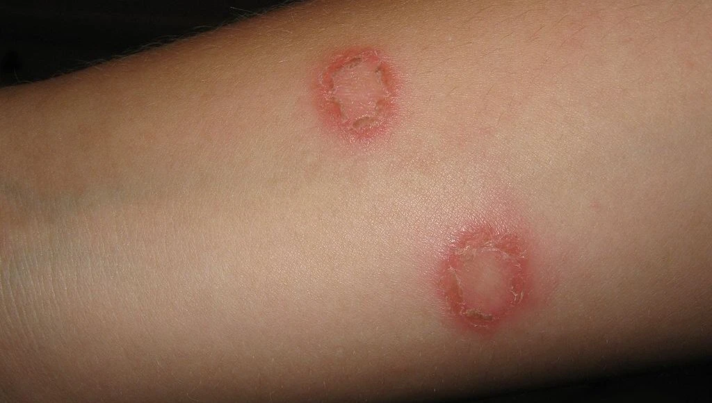 Homeopathic Remedies for Fungal Infections