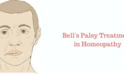 Bell's Palsy Homeopathy