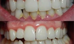 gingivitis homeopathic medicines