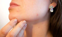 acne myths and facts